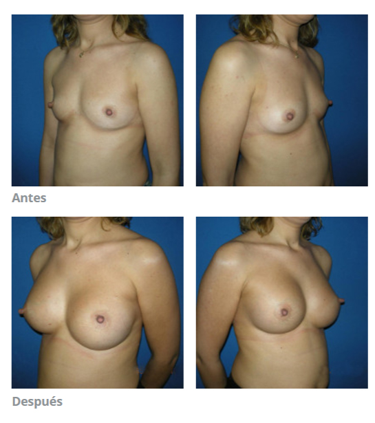 aumento de pecho cordoba antes despues
