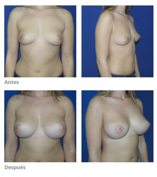 aumento de pecho en cordoba antes despues